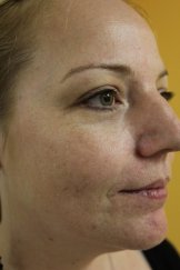 Vampire Facial 6 - Before Treatment